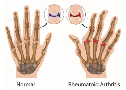Arthritis treatment. service image